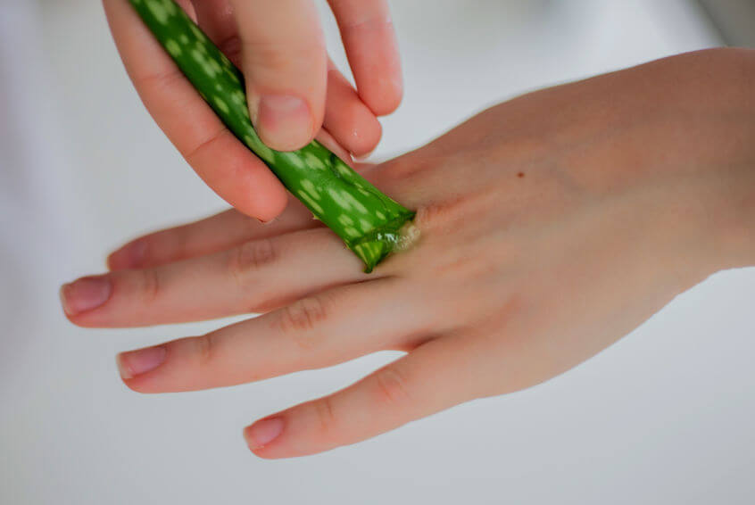 aloe vera for burns