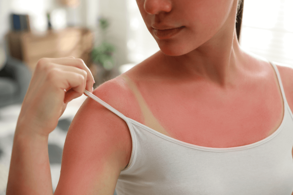 Top Foods for Sunburn