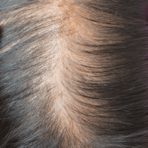 Thinning hair